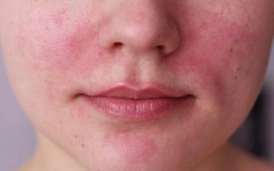 rosacea