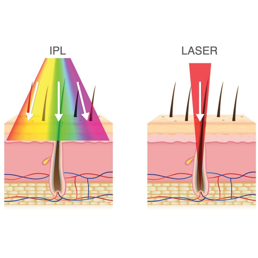 Diferencia entre Depilación IPL y Depilación Láser Dermaclínica
