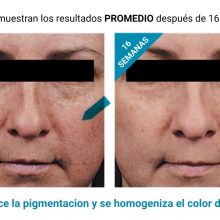 antes-y-despues-phloretin-cf