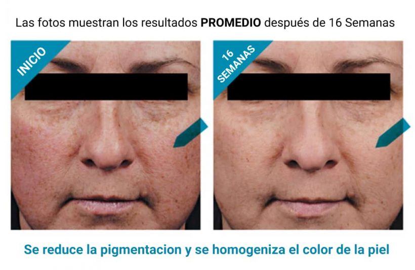 antes-y-despues-phloretin-cf