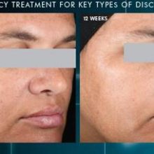 efecto-discoloration-defense
